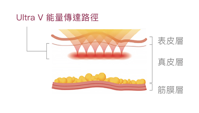 HIFU原理